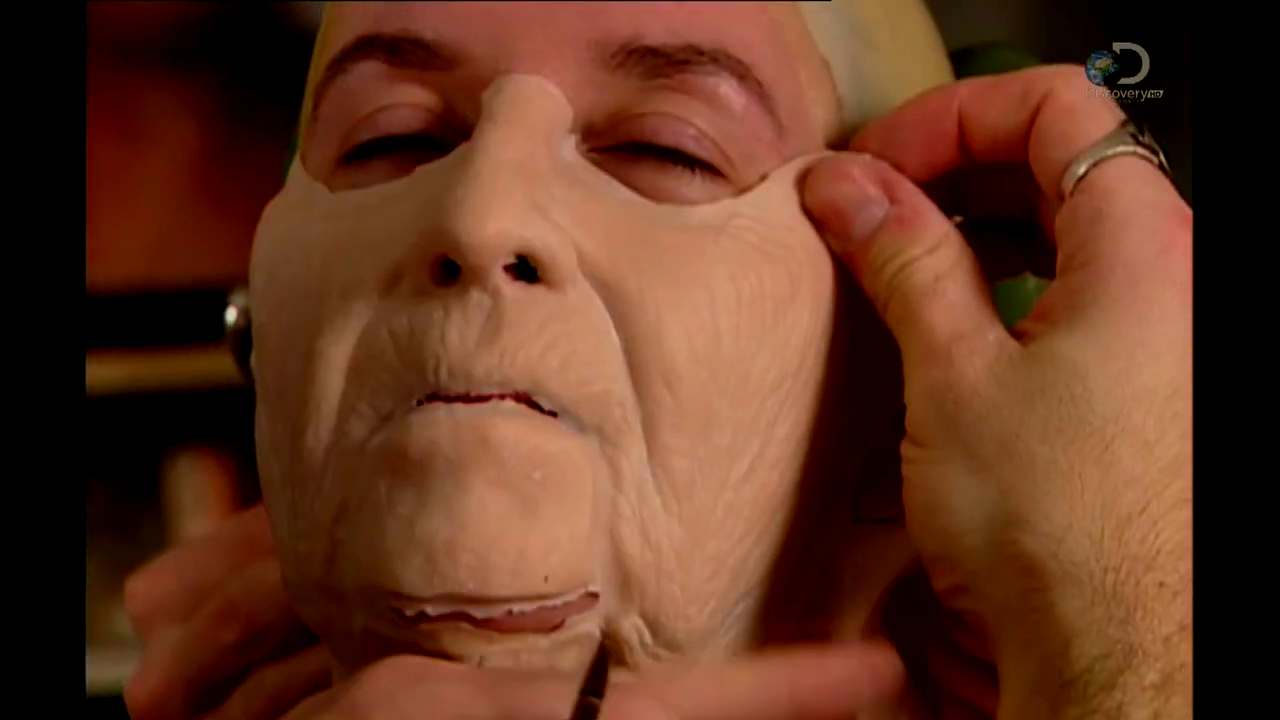 Collage de la prothèse en commencent par la pièce la plus grand